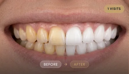 Teeth Whitening